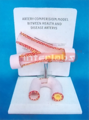 ARTERY COMPARISON MODEL BETWEEN HEALTH AND DISEASE ARTERY